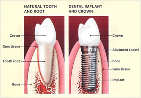 Restore Your Smile! - Dental Implants in Langhorne, PA